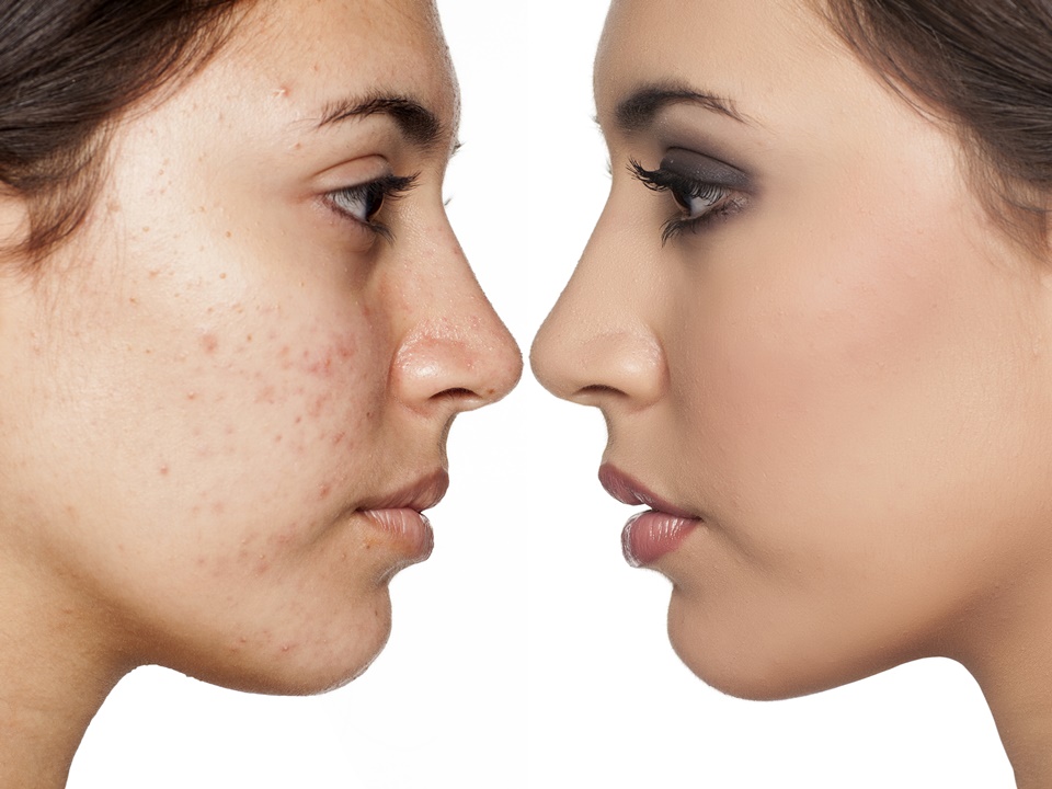 Imagen Tratamiento Manchas